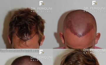 Hair restoration procedure before and after results