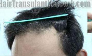 Hair transplantation surgery before and after pictures