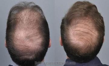 Hair transplantation surgery before and after images