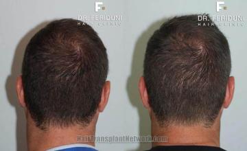 Hair restoration procedure before and after pictures