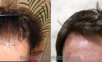 Hair restoration procedure before and after results