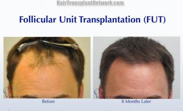 Hair restoration procedure before and after results