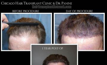 Hair restoration procedure before and after results