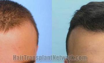 Hair transplantation surgery before and after photos