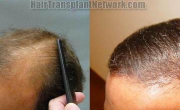 Hair restoration procedure pictures - Left view