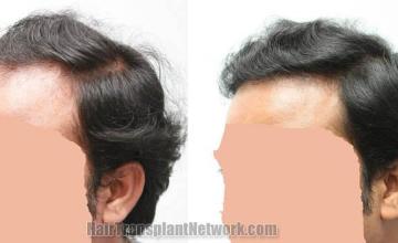 Hair transplantation surgery before and after photos