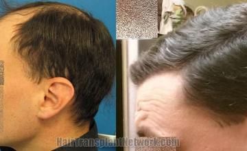 Hair restoration procedure before and after pictures