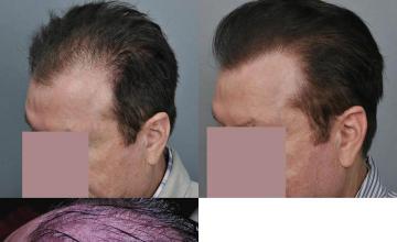 Hair transplantation surgery before and after pictures