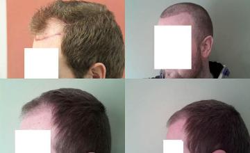 Hair restoration procedure results