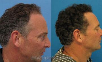 Hair restoration procedure results