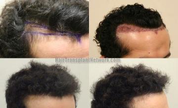 Hair restoration procedure before and after results