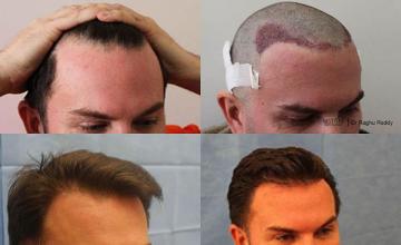 Hair transplantation surgery before and after images