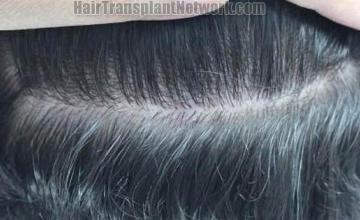 Hair restoration procedure before and after pictures