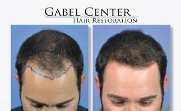 Hair transplantation surgery before and after photos