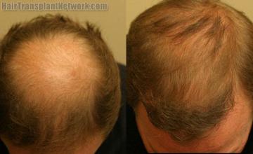 Top view - Before and after hair restoration photos