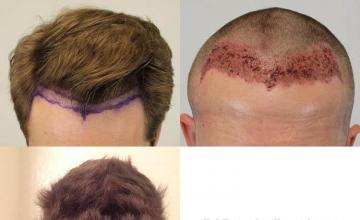 Top view before and after hair restoration results