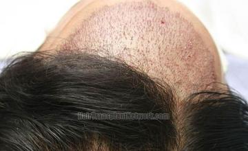 Hair restoration surgery before and after photos