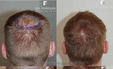 Before and after hair transplantation procedure