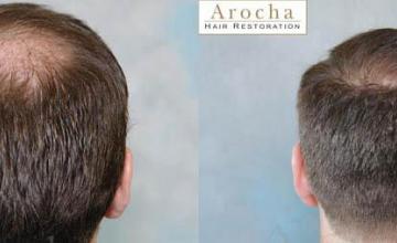 Back view before and after hair transplantation photos