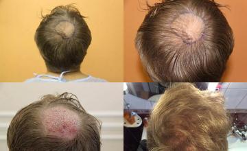 Hair restoration procedure before and after pictures