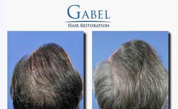 Surgical hair transplantation result photographs