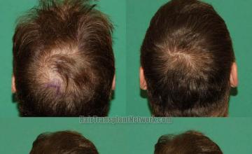 Hair restoration procedure before and after pictures