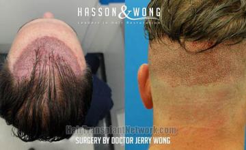 Hair restoration procedure before and after result images