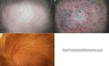 Hair transplantation surgery before and after images