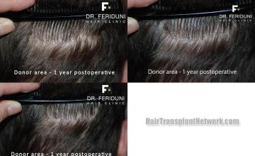 Hair transplant surgery before and after images