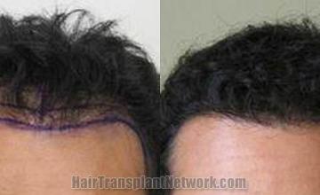 Hair transplantation surgery before and after photos