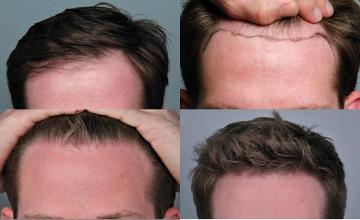 Hair restoration procedure before and after results