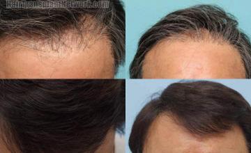 Hair restoration procedure before and after results