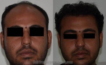 Before and after hair transplant procedure images