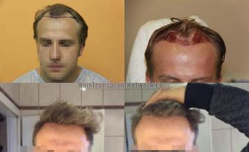 Before and after hair transplant procedure images