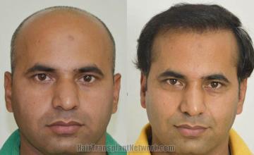 Hair transplantation surgery before and after photos