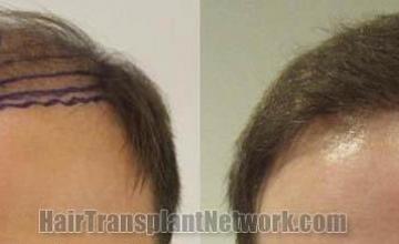 Hair restoration procedure before and after results