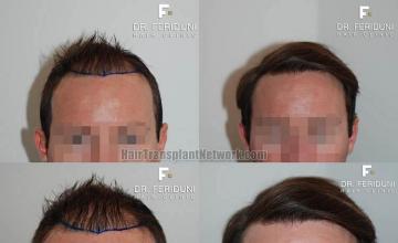 Front view - Before and after hair transplantation surgery