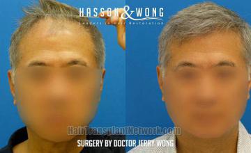 Before and after hair restoration procedure images