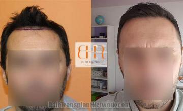 Before and after hair restoration procedure images