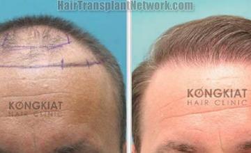 Front view - Before and after hair transplantation surgery