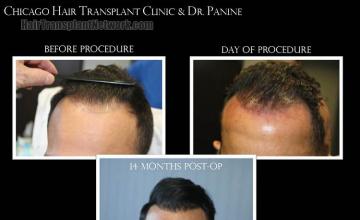 Front view - Before and after hair restoration procedure