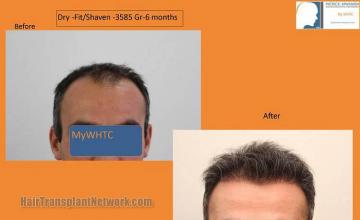 Hair restoration procedure before and after results