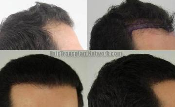 Hair transplantation surgery before and after images