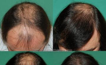 Top view before and after hair restoration results