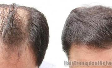 Top view before and after hair restoration results