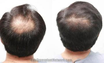 Back view before and after hair transplantation photos