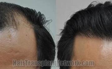 Hair restoration procedure before and after results