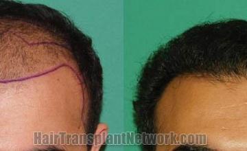 Before and after hair transplant procedure images