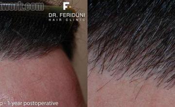 After photos of hair transplant surgery hairline closeups