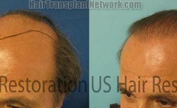 Hair replacement procedure before and after photos